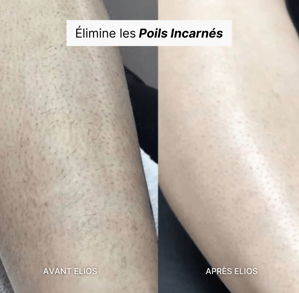 Elvéra™ | Rasoir Femme 5-en-1